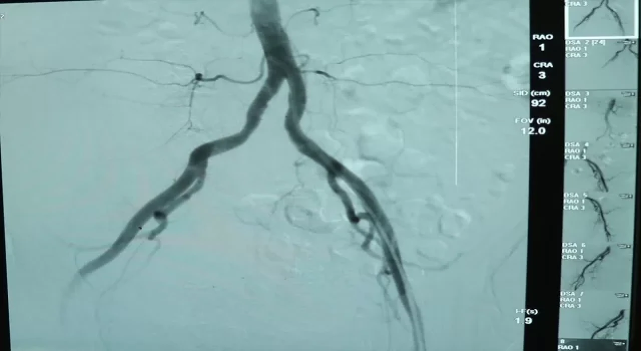 İç kanamalı hasta ”anjiyo ile embolizasyon” yöntemiyle sağlığına kavuşturuldu