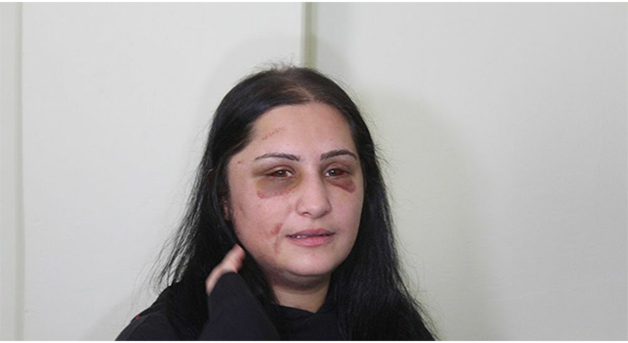 Eski eşinin öldüresiye darp ettiği kadın konuştu: En ağır ceza olmalı