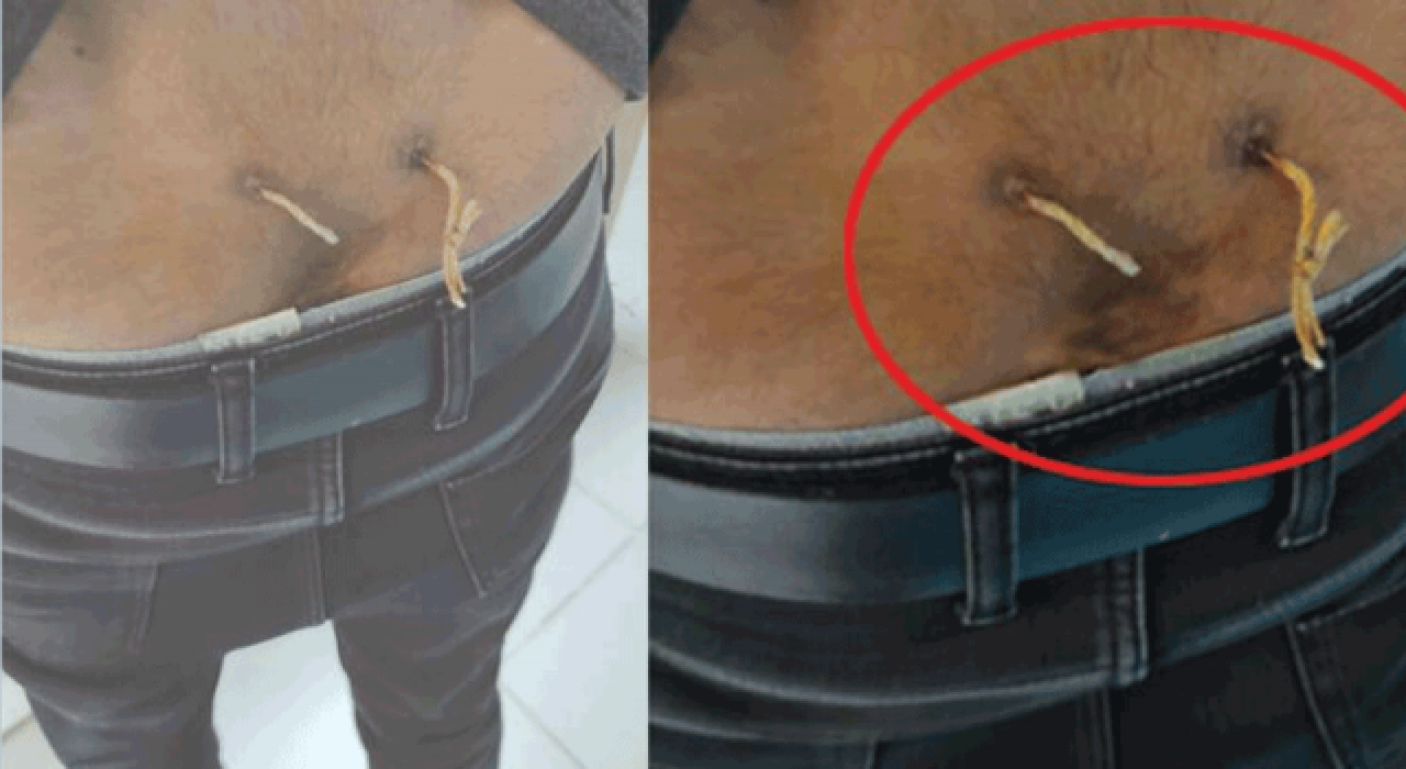 "Alternatif tıp" adı altında işkence: Beline delik açıp, deri altından çamaşır ipi geçirmişler