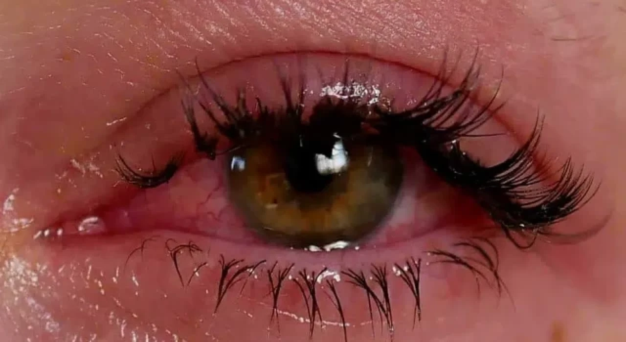 Bahar mevsiminde göz alerjilerine dikkat edilmeli