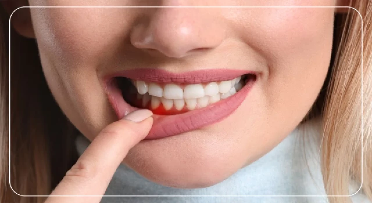 Diş Kaybının Nedenleri Nelerdir?