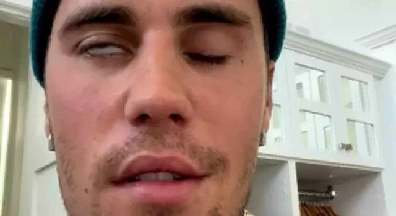 Ramsay Hunt sendromu nedir?