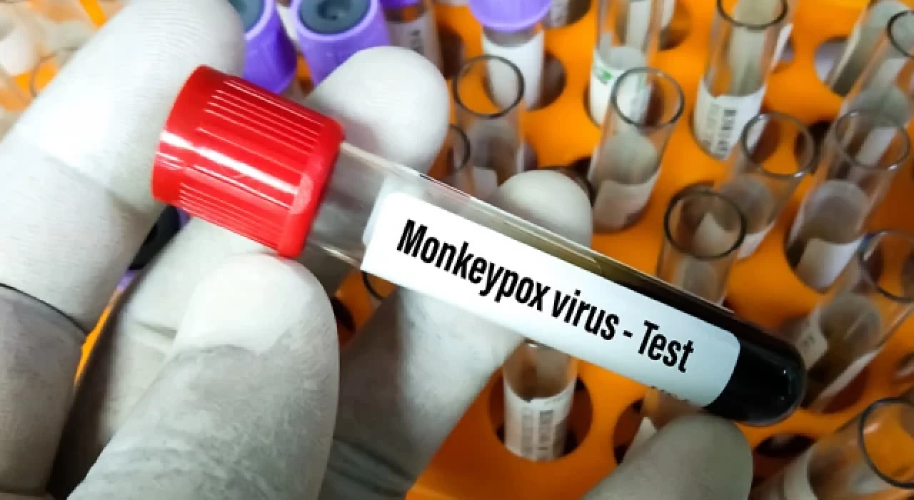 Türkiye'de ilk maymun çiçeği vakası tespit edildi