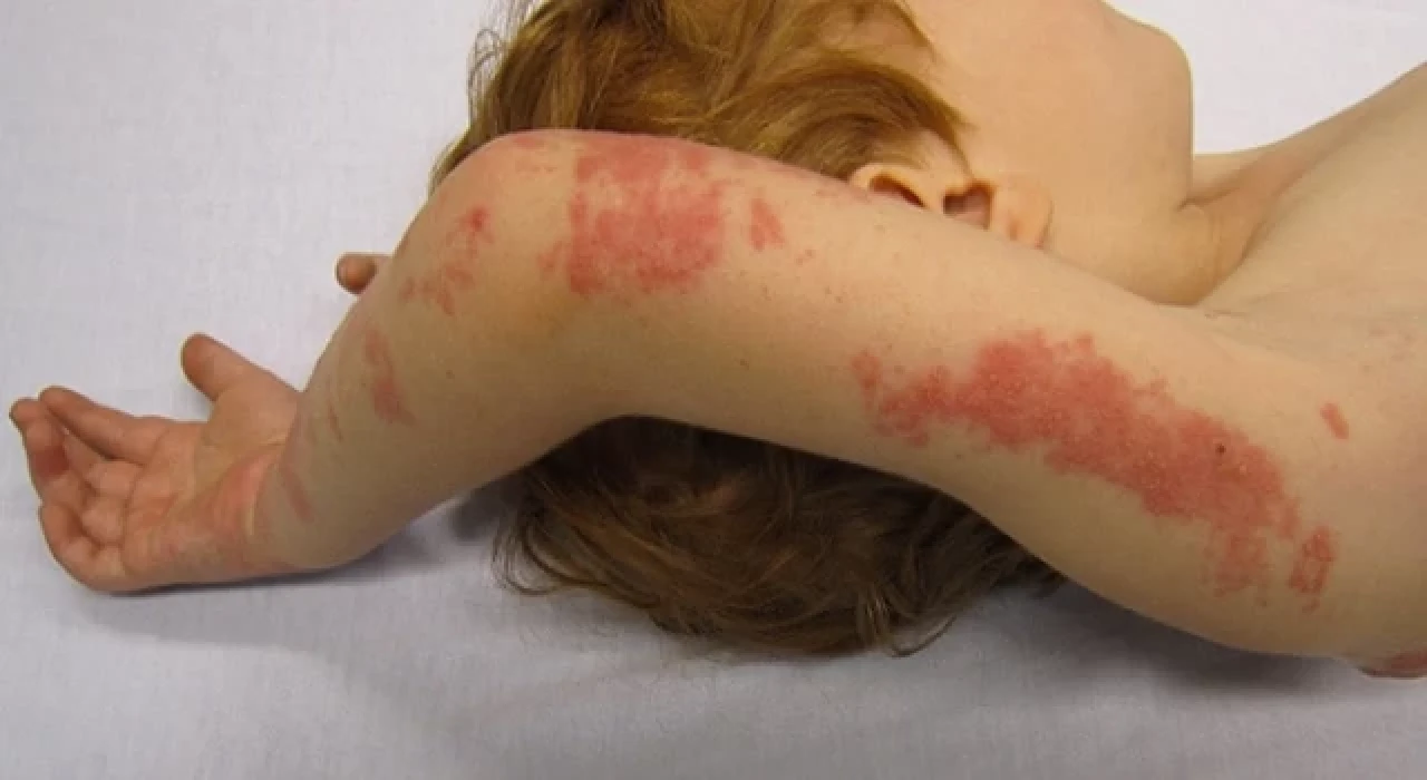 Zona, suçiçeğinin yeniden aktif hale gelmesidir