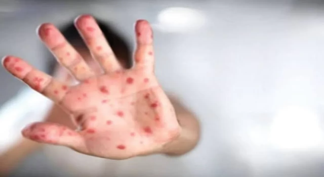 “Maymun çiçeği virüsü, anne karnındaki bebeğe ulaşabilir”