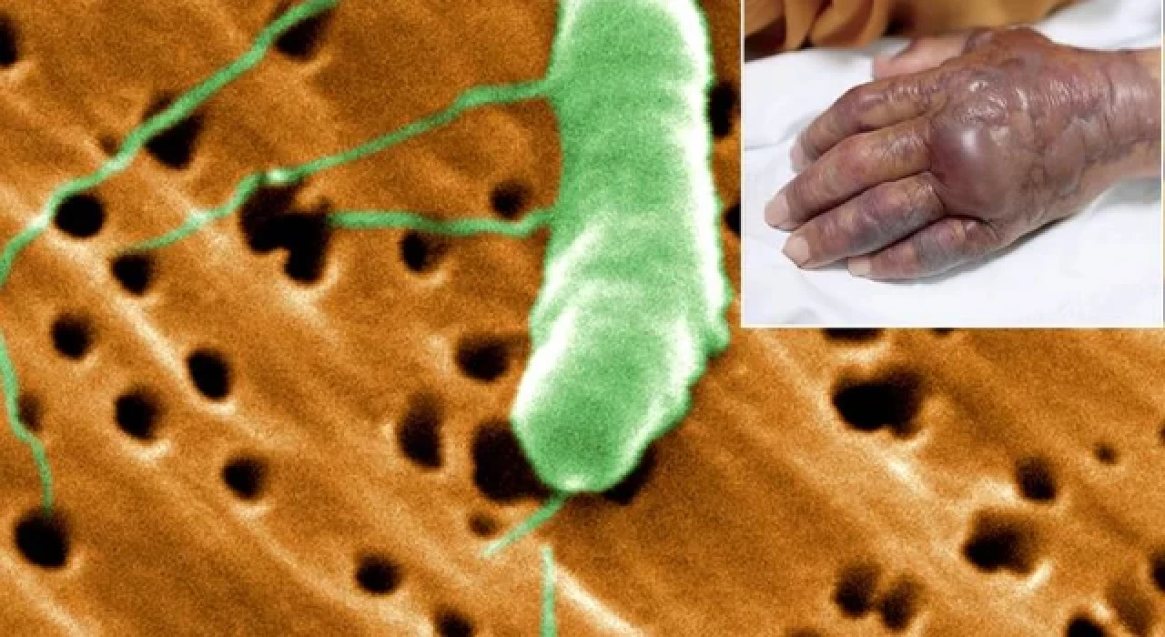 Et yiyen bakteri vakaları artış gösteriyor