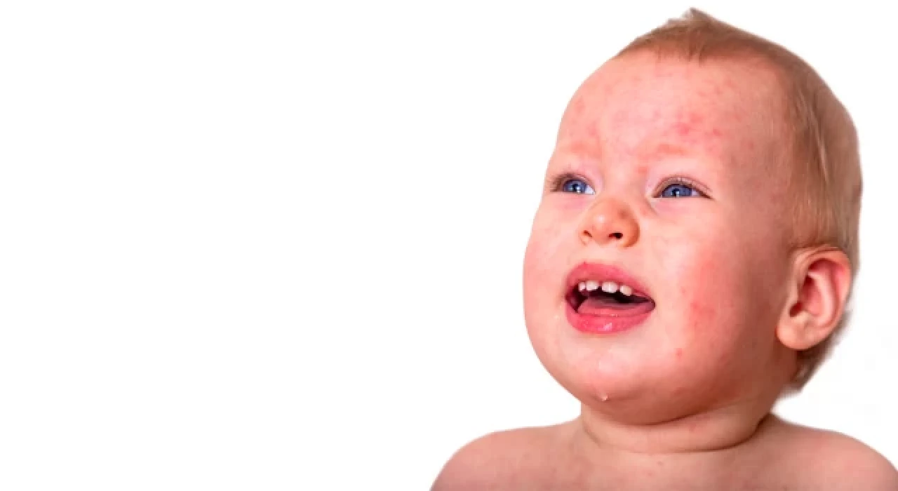 Kızamık'ta vaka sayıları fırladı