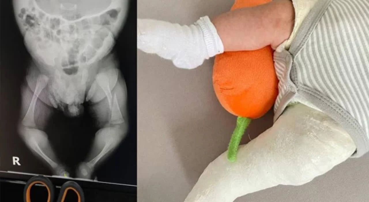 Özel hastanede skandal; bir aylık bebeğin ayağı kırıldı, bakanlık soruşturma izni vermedi