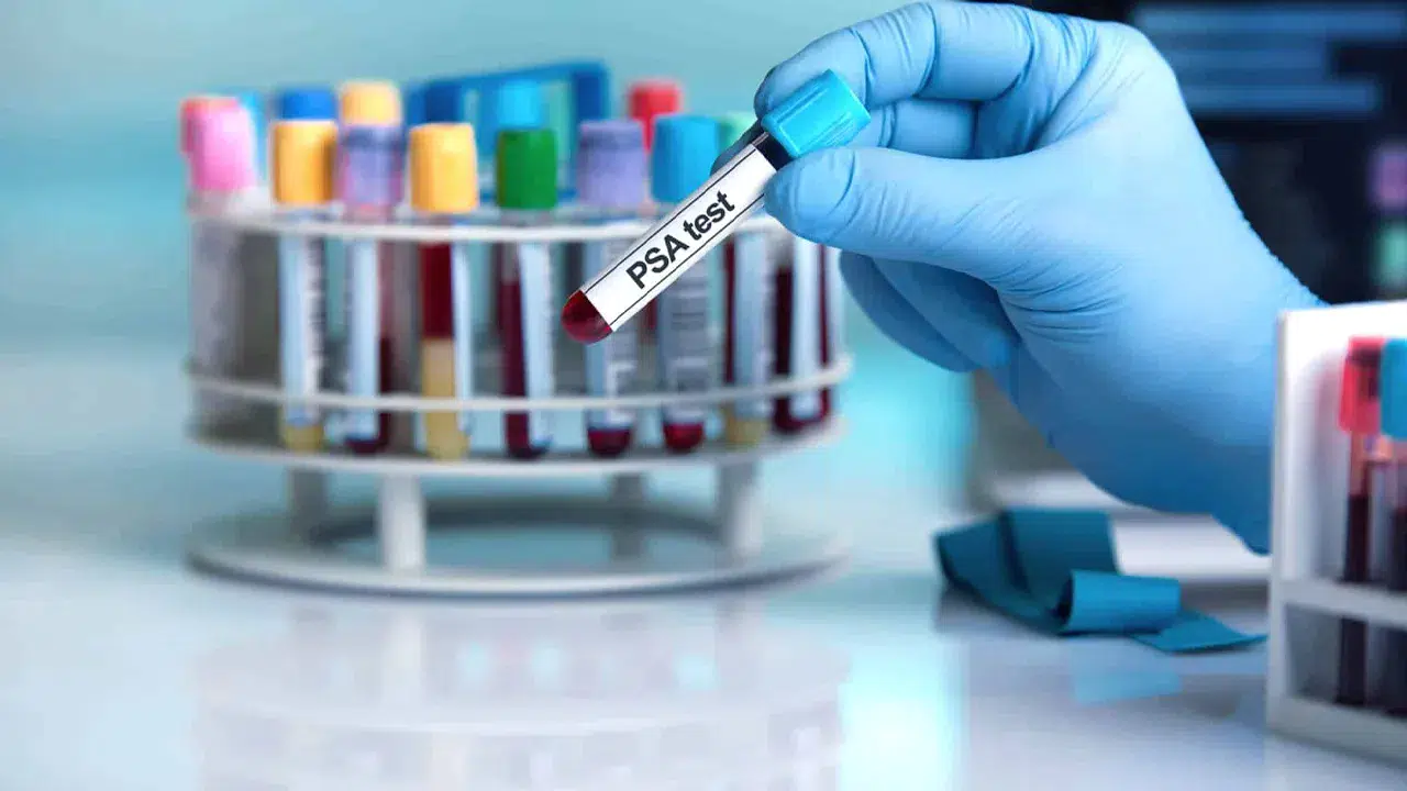 Avrupa’da 160 bin erkekle yapılan araştırma: PSA testi prostat kanserinden ölümleri azaltıyor