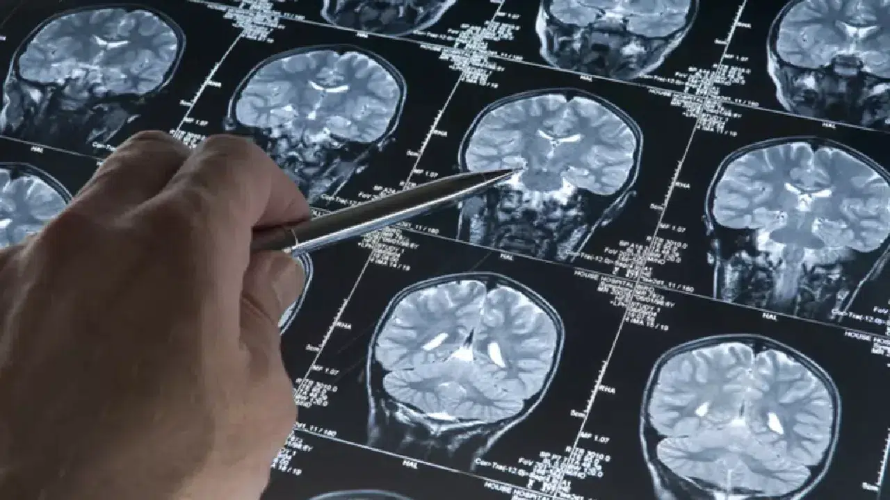 Dünyada sadece 13 kişide görülen gizemli beyin hastalığı keşfedildi