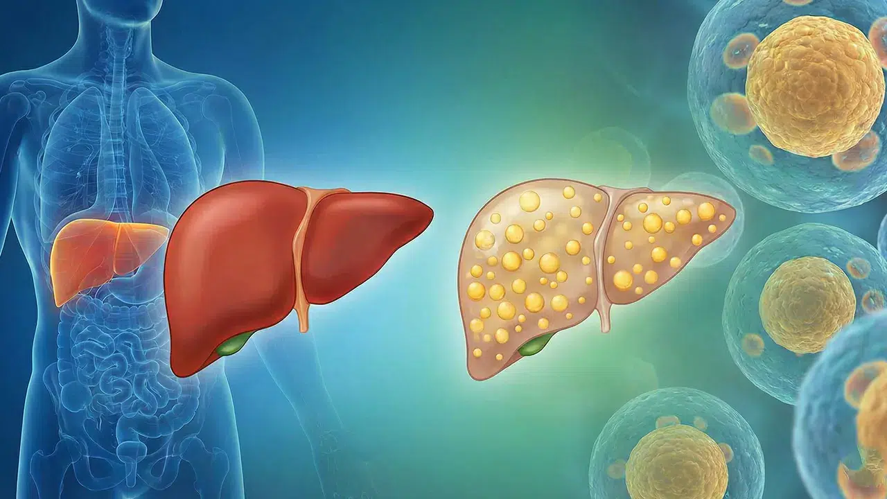 Karaciğer yağlanması her 4 bireyden 1'inin problemi!