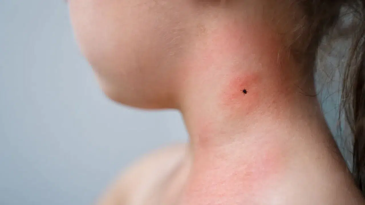 Lyme hastalığı nedir, belirtileri nelerdir? Lyme hastalığının tedavisi var mı?