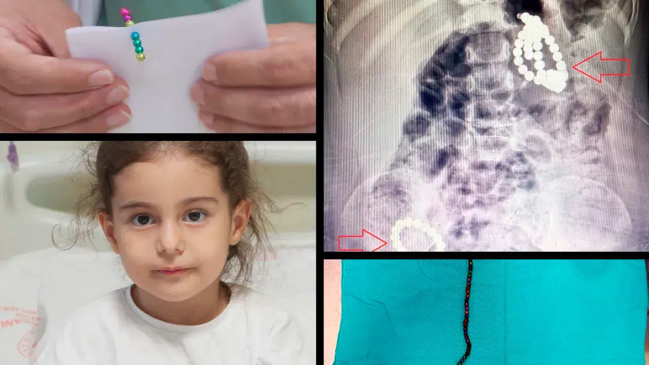 Gördüklerine doktorlar bile şok oldu:  3 yaşındaki çocuğun karnından 66 adet mıknatıs çıktı!