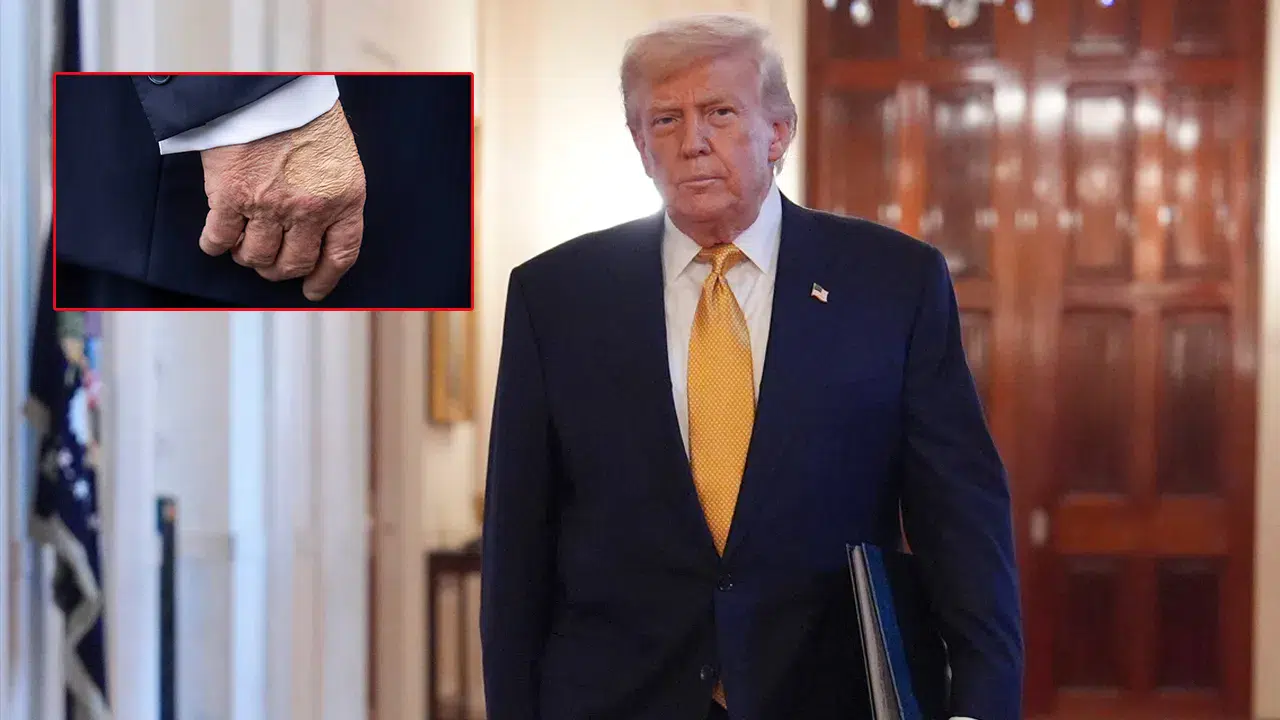 Beyaz Saray, Trump'ın vücudundaki şişlik ve morluklara ilişkin açıklama yayınladı