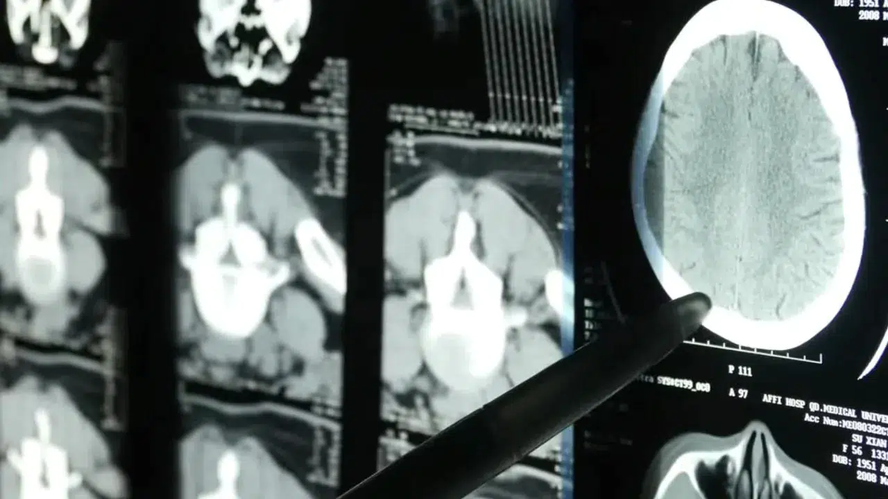 Alzheimer erken teşhisinde devrim: Beyin kan akışı hastalığı ele veriyor