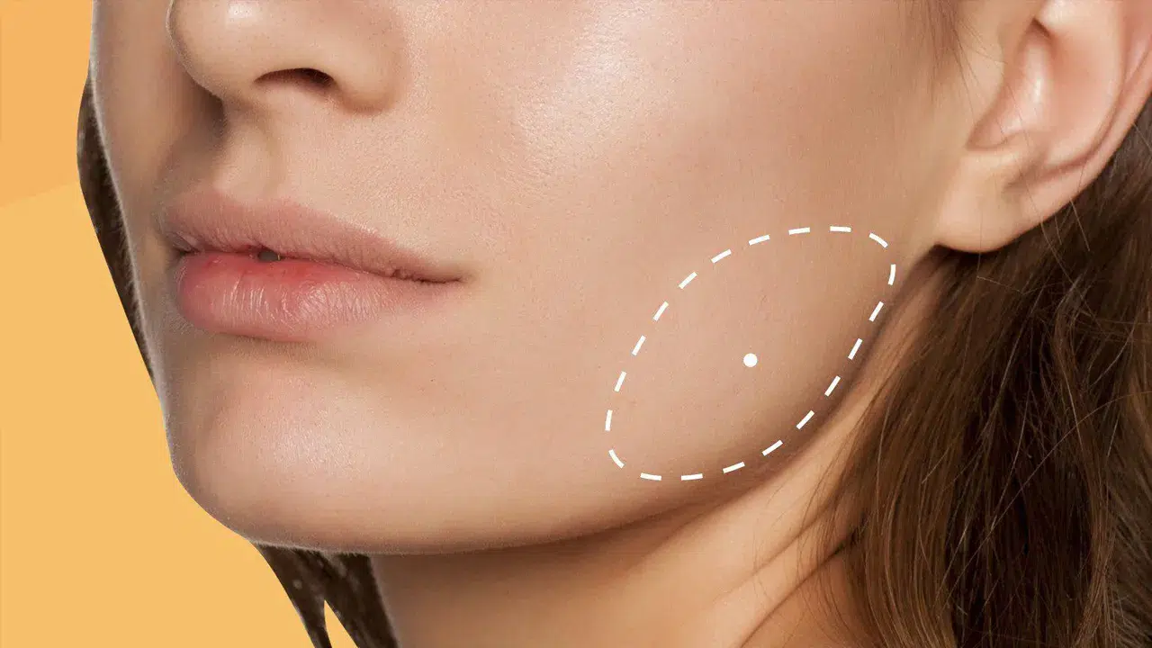 Masseter Botoks: Kalıcı mı, Geçici mi?