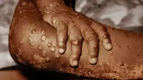 Güney Afrika'da M çiçeği alarmı: Beş haftada 13 yeni vaka tespit edildi