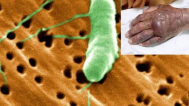 Et yiyen bakteri vakaları artış gösteriyor