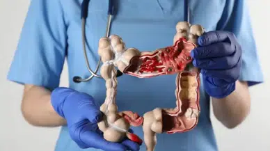 Kolon kanserine davetiye çıkaran tehlikeli alışkanlıklar