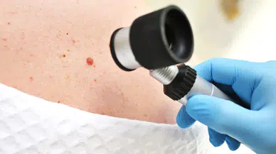 HPV’nin yeni türü cilt kanserine neden olabilir: Bilim insanlarından çarpıcı keşif