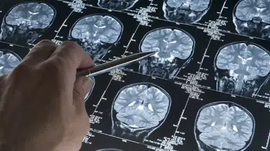 Dünyada sadece 13 kişide görülen gizemli beyin hastalığı keşfedildi