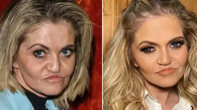 Uyuşturucu bağımlılığı yüzünü yok etti: Danniella Westbrook yaşadıklarını anlattı