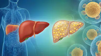 Karaciğer yağlanması her 4 bireyden 1'inin problemi!