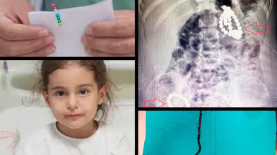 Gördüklerine doktorlar bile şok oldu:  3 yaşındaki çocuğun karnından 66 adet mıknatıs çıktı!