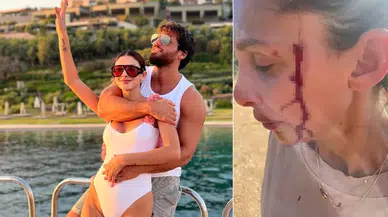 Can Yaman’ın sevgilisi Sara Bluma eski partneri tarafından şiddet gördüğünü açıkladı