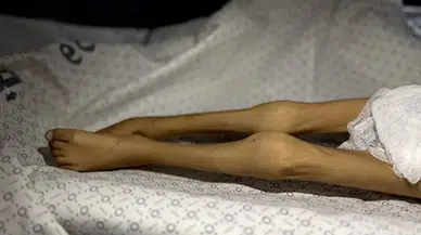 BM’den Gazze uyarısı: Açlık ölümleri ‘sıradanlaştı’, sağlık sistemi yok ediliyor