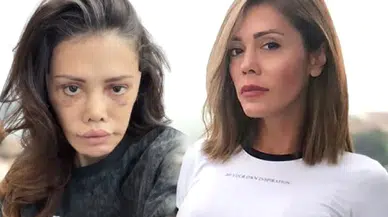 Yüz nakli yaptırmasıyla gündem olan Didem Ceran, ağlayarak hastalığını açıkladı