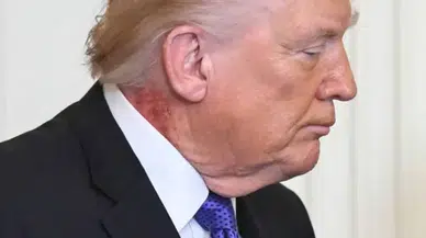 Donald Trump'ın boynundaki kızarıklık gündem oldu: Doktordan resmi açıklama geldi