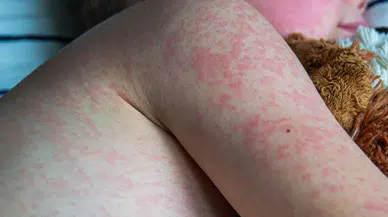 ABD’de kızamık salgını büyüyor: 600’ü aşkın vaka bildirildi