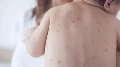 Bangladeş'te kızamık salgını: 6 haftada 113 çocuk hayatını kaybetti