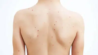 Okullarda suçiçeği alarmı: Uzmanlardan ailelere kritik uyarı