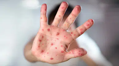 ABD'de kızamık alarmı: Dr. Mehmet Oz'dan "Aşı olun" çağrısı