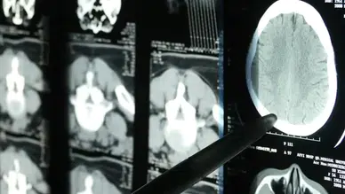 Alzheimer erken teşhisinde devrim: Beyin kan akışı hastalığı ele veriyor