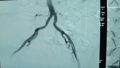 İç kanamalı hasta ”anjiyo ile embolizasyon” yöntemiyle sağlığına kavuşturuldu