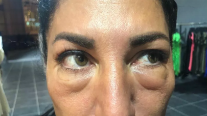 Gözaltı ışık dolgusu yaptırdı: Yüz felci geçirdi, 7 aydır şişlikleri inmiyor