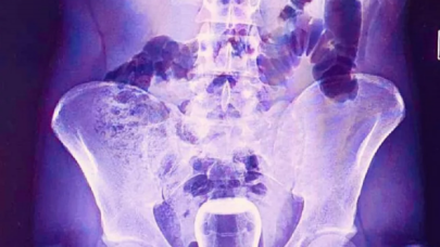 Basur için yapılan hacamat kazaya yol açtı: Çay bardağı ameliyatla çıktı