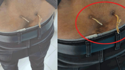 "Alternatif tıp" adı altında işkence: Beline delik açıp, deri altından çamaşır ipi geçirmişler