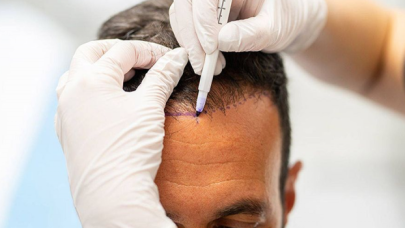 Bağcılar'da saç ekimi sırasında ölüm iddiası: Doktor gözaltına alındı