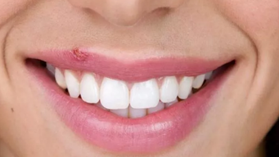 Herpes virüsü enfeksiyonlarına dikkat