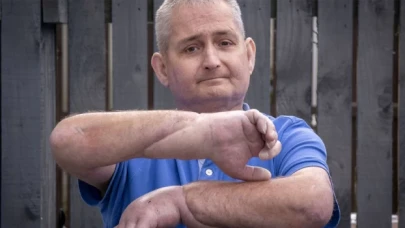 İngiltere'de dünyanın ilk çift el nakli başarıyla gerçekleştirildi