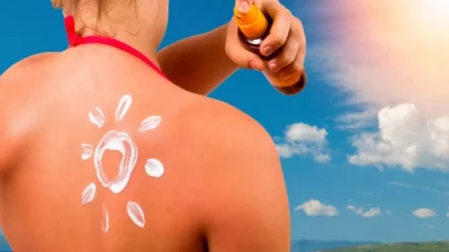 Güneş yanığına ne iyi gelir?