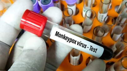 Türkiye'de ilk maymun çiçeği vakası tespit edildi