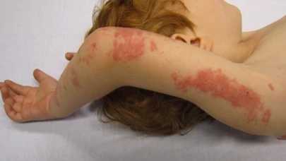 Zona, suçiçeğinin yeniden aktif hale gelmesidir