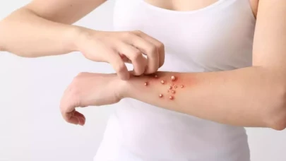 ABD’de maymun çiçeği virüsü nedeniyle acil durum ilan edildi