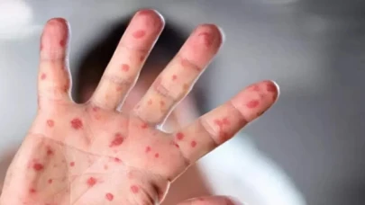 DSÖ’den maymun çiçeği varyantlarının ismini değiştirme kararı