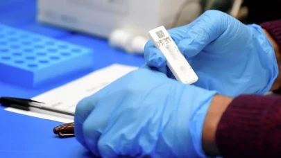 Dünyada bir ilk: Maymun çiçeği, Kovid-19 ve HIV aynı anda pozitif çıktı